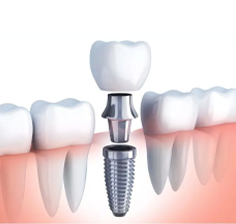 ایمپلنت در مطب دکتر آزیتا هدایتی