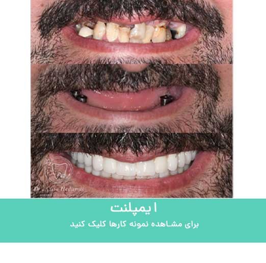 نمونه کار ایمپلنت